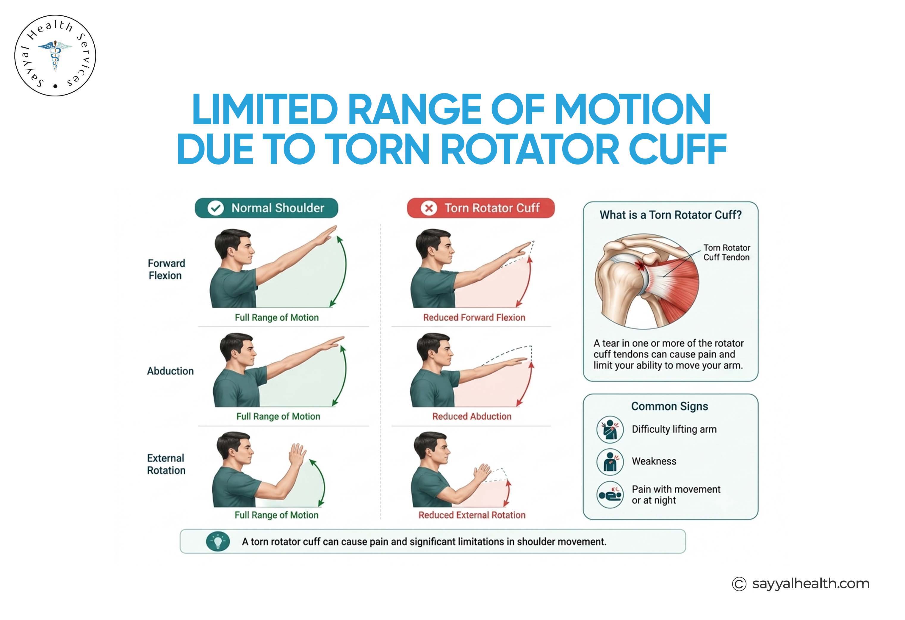 limited range of motion due to torn rotator cuff